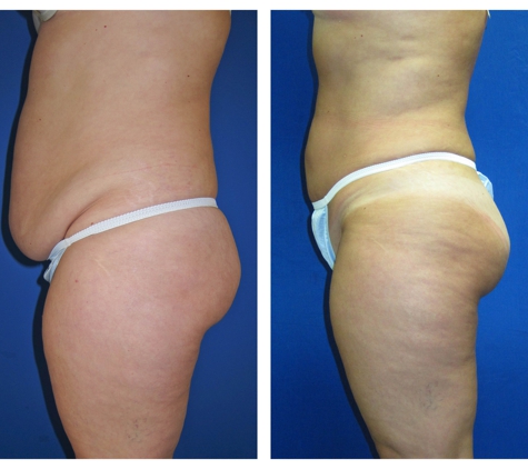 Infini Phoenix Liposuction - Scottsdale, AZ