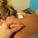 Barnett Chiropractic & Acupuncture Clinic - Acupuncture