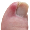 Ingrown Toenail Therapy gallery