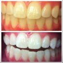 Transparent Smiles - Teeth Whitening Products & Services