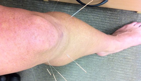 Physio Noosa