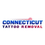 Connecticut Tattoo Removal