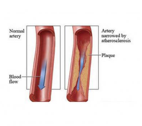 USA Vascular Centers - Southampton, PA