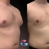 Gynecomastia Surgery Center in Los Angeles gallery