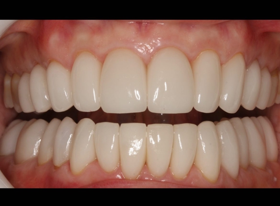 Advanced Dentistry of Amarillo - Amarillo, TX. Cosmetic smile rejuvenation by Dr. Trey Miller