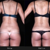 bodySCULPT® gallery