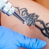 Removery Tattoo Removal & Fading gallery