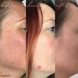 Crystal Skin Care - Kaysville, UT. Freezing: Before and After