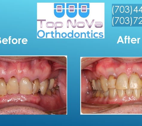 Top Nova Orthodontics - Sterling, VA