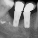 Great Boca Smiles - Implant Dentistry