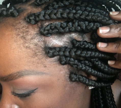 Francin's African Hair Braiding - Herndon, VA. You can see how tight they pulled my hair although I requested they didn't braid my hair tight. They're also different sizes throughout.