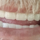 Affordable Dentures & Implants