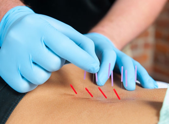 Monte Sano Acupuncture & Healing Arts - Huntsville, AL. Acupuncture-Dry Needling is just one of the many drug-free approaches to pain & injury care with Dr. Mick