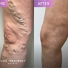 Vein Treatment Clinic Huntington Beach gallery
