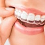 Braces Orthodontics Pediatrics-Bop Braces
