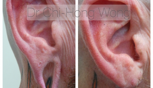 Cosmetic Laser & Skin Cancer Centre - Brendale, QLD. Before and After Earlobe Repairs by Dr Wong