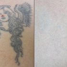 Vanish Laser Tattoo Removal and Skin Aesthetics