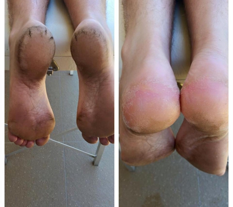 Country Podiatry - Dubbo, NSW. Before And After