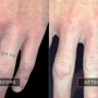 Removery Tattoo Removal & Fading