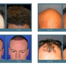 Complete Hair Restoration - Hair Replacement