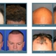 Complete Hair Restoration