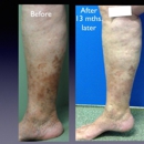 Scarless Vein Care by Dr. Kamran - Wilmington