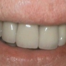 Tolman Dentistry - Implant Dentistry