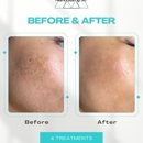 Deromano Skincare - Hair Removal