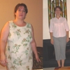 Gastric Sleeve Mexico gallery