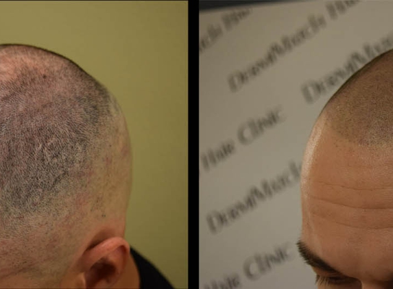 DermiMatch Hair Clinic - SMP (scalp micropigmentation) - Phoenix, AZ