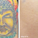 Laser Tattoo Removal by Tatt Cemetery - Tattoo Removal
