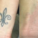 ReversaTatt Tattoo Removal - Tattoo Removal