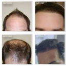 Natural Transplants, Hair Restoration Clinic - Medical Clinics
