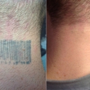 Tataway - Tattoo Removal