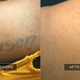 Removery Tattoo Removal & Fading