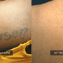 Removery Tattoo Removal & Fading