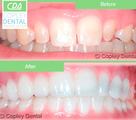 Copley Dental Associates - Boston, MA. #veneer
#cosmeticdentist