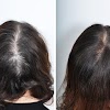 PRP Hair Loss Treatment Center gallery