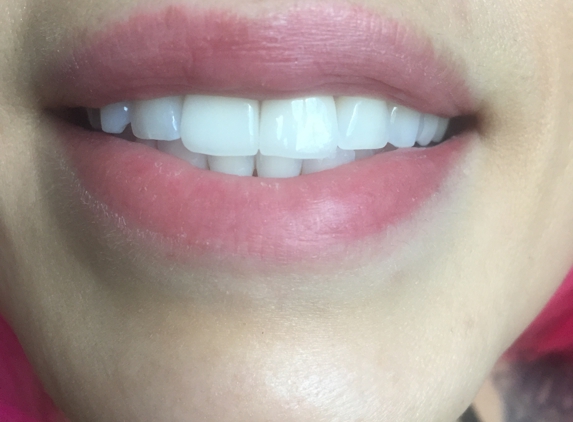Star Bright Dental - Westminster, CA. Perfect pearly whites done by Dr. Nguyen @Star Bright Dental.