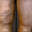 USA Vein Clinics - Mundelein - Medical Clinics