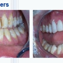 Cooper Family Dentistry - Teeth Whitening Products & Services