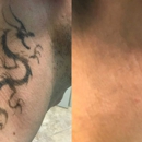 ReversaTatt Tattoo Removal - Day Spas
