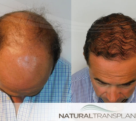 Natural Transplants, Hair Restoration Clinic - Fort Lauderdale, FL