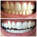 Glintr Mobile Teeth Whitening - Teeth Whitening Products & Services