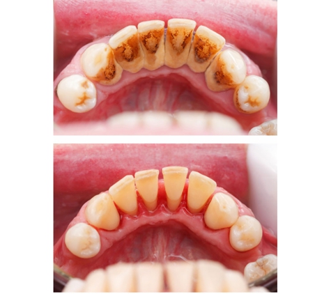 Brice Dental Surgery - Ayr, QLD. Scaling before and after