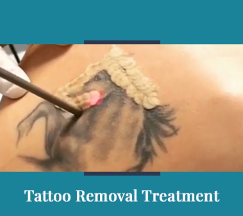Newcastle Cosmetic Doctor - Broadmeadow, NSW. Tattoo Removal Treatment