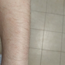 Ideal Image Laser Hair Removal - Hair Removal