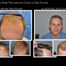 Chicago Hair Transplant Clinic - Hair Replacement