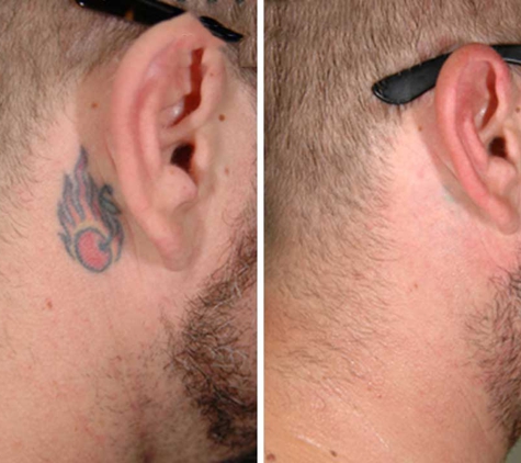 ReversaTatt Tattoo Removal - Brandon, FL