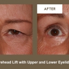 Klapper Eyelid & Facial gallery